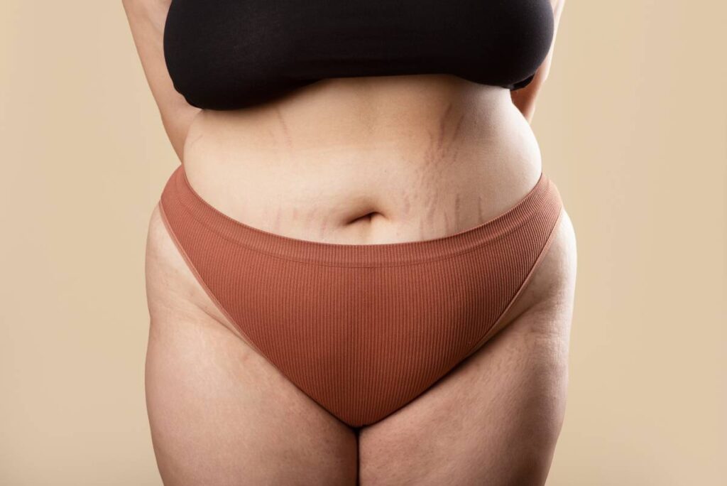 como tratar lipedema nas pernas