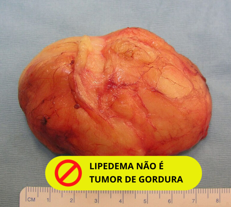 lipedema não é tumor de gordura