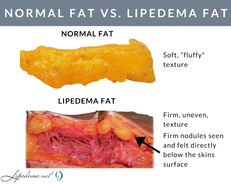Lipedema – Excesso de gordura localizada pode ser sinal de
