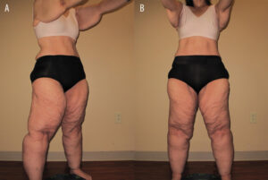 lipedema braços antes e depois