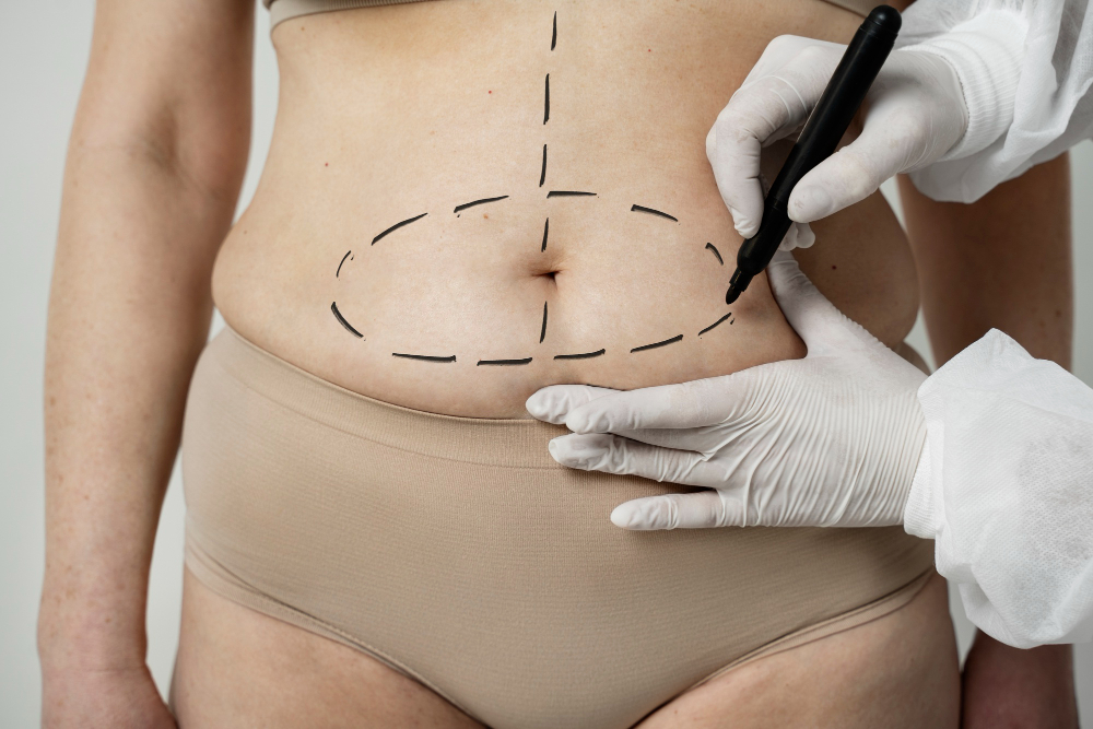 abdominoplastia em ancora