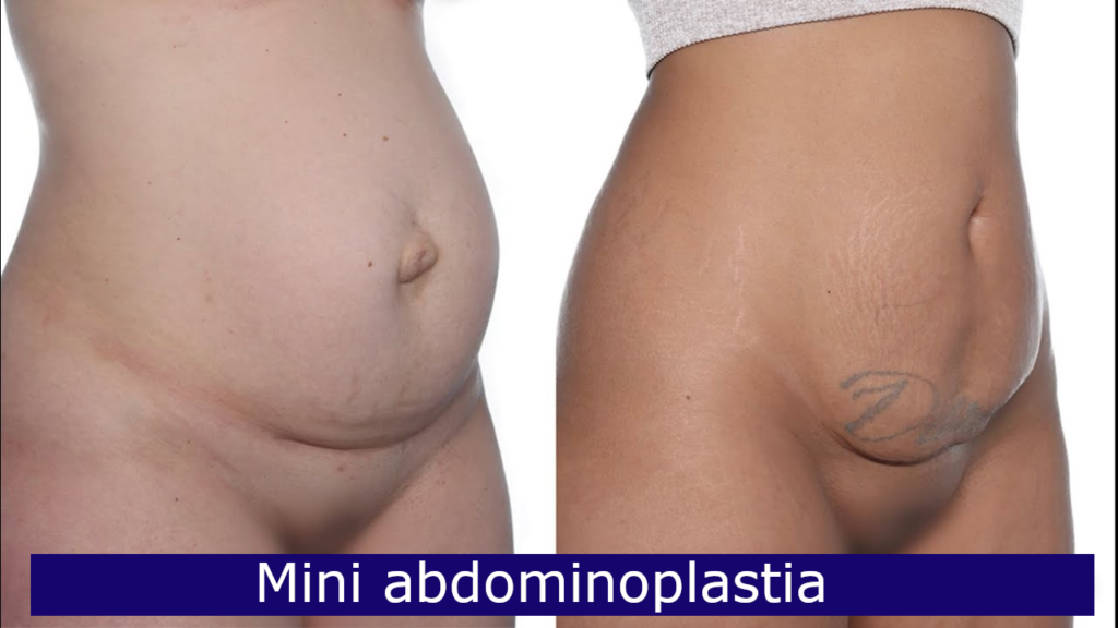 mini abdominoplastia