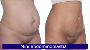 mini abdominoplastia