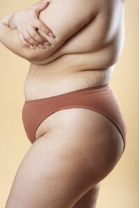 lipedema no quadril