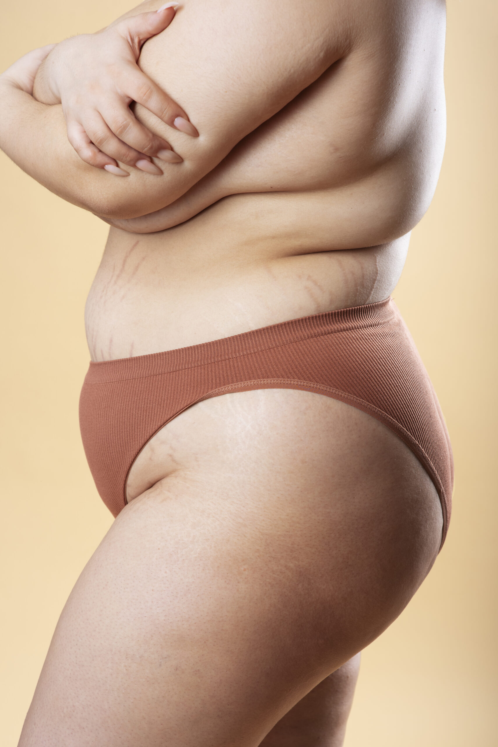 lipedema no quadril