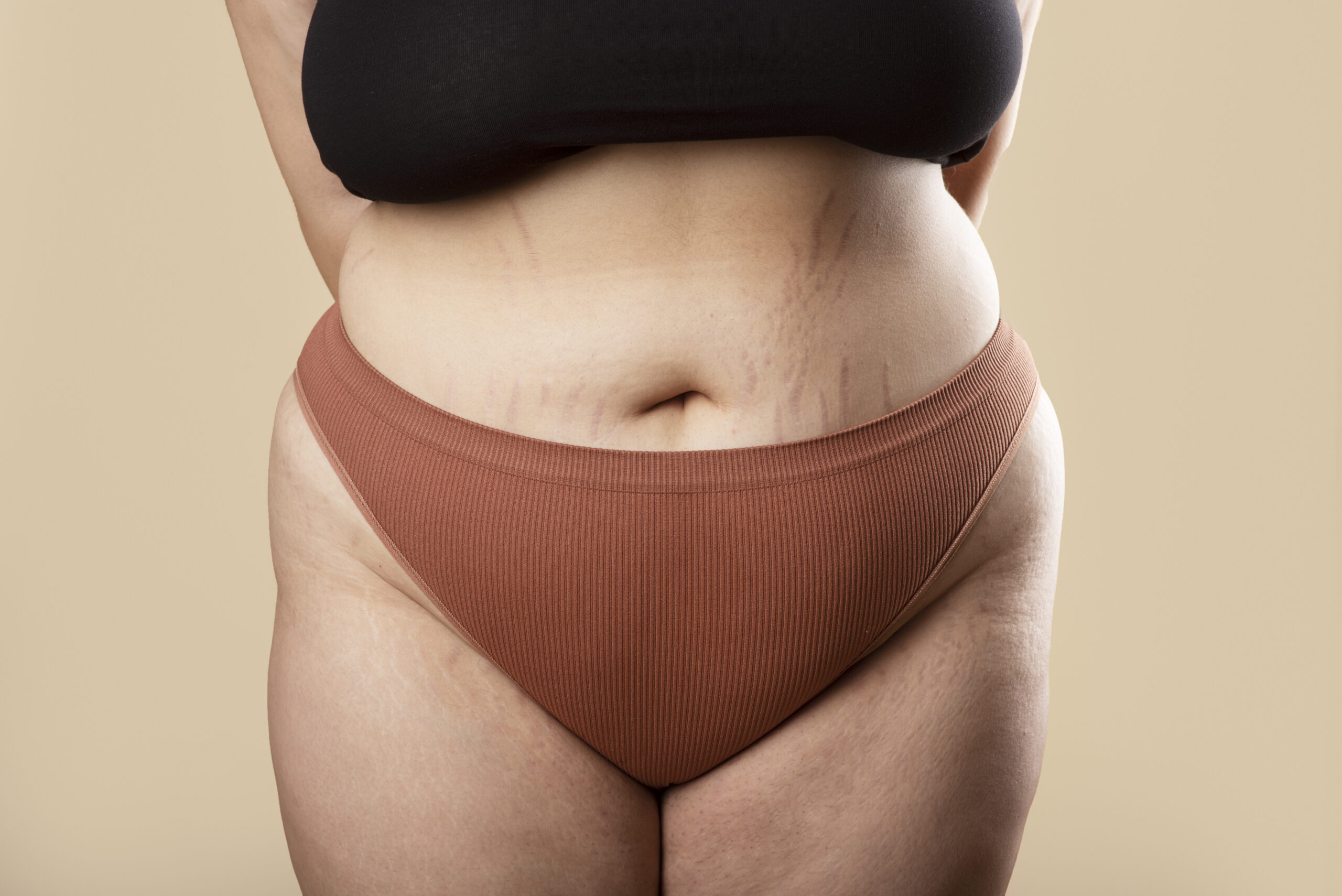 exame_para_diagnostico_de_lipedema