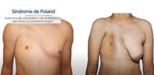 sindrome poland