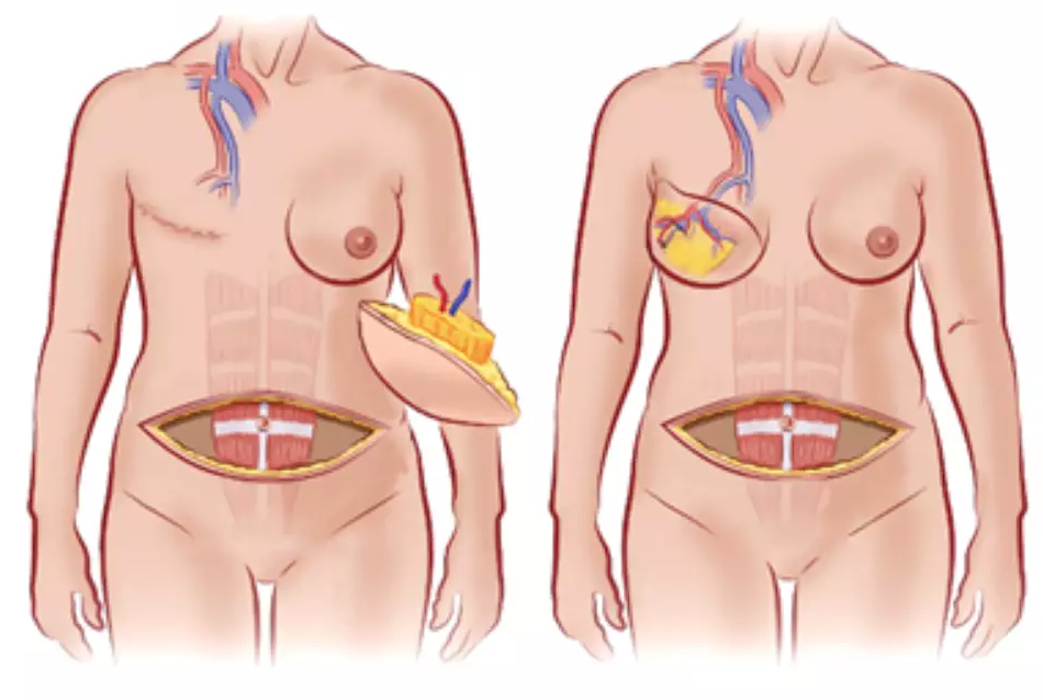 Retalho Microcirúrgico DIEP para Reconstrução da Mama