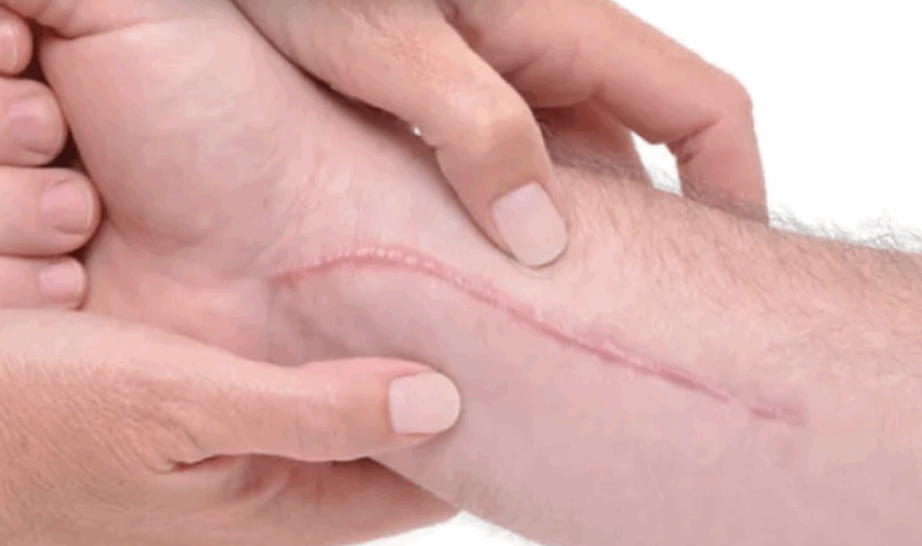 cicatriz hipertrofica