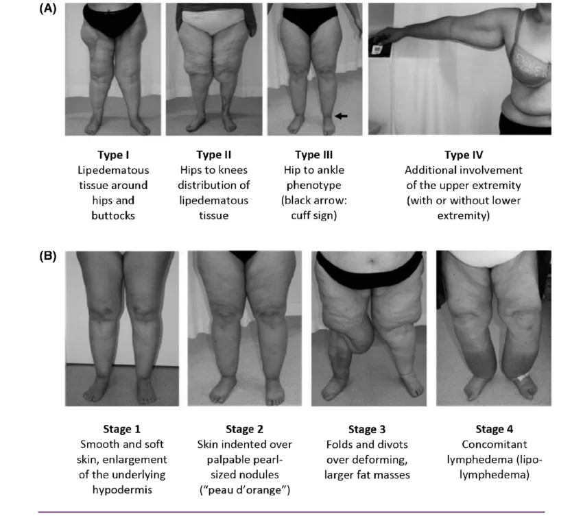 fotos tipos de lipedema