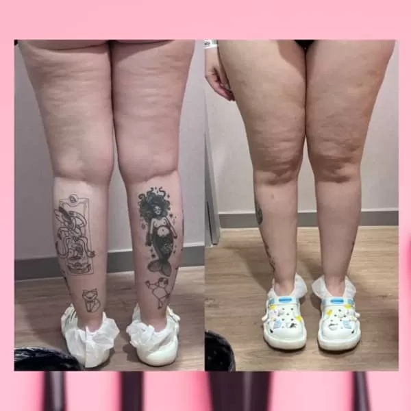 karen bachini lipedema nas pernas