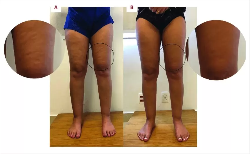 foto lipedema antes e depois