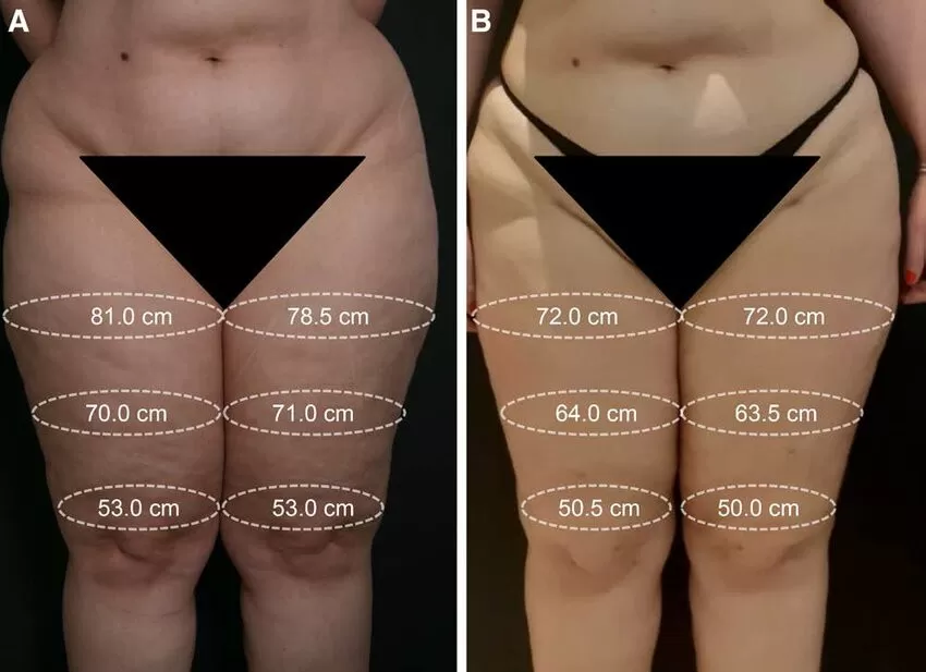 lipedema antes e depois