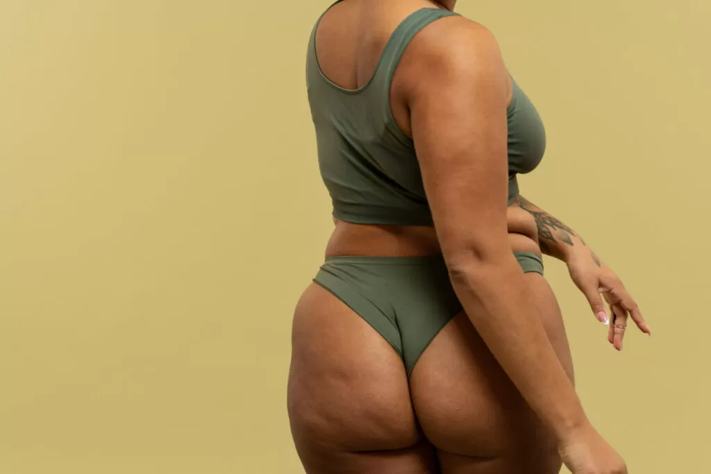 remedio natural para tratar lipedema