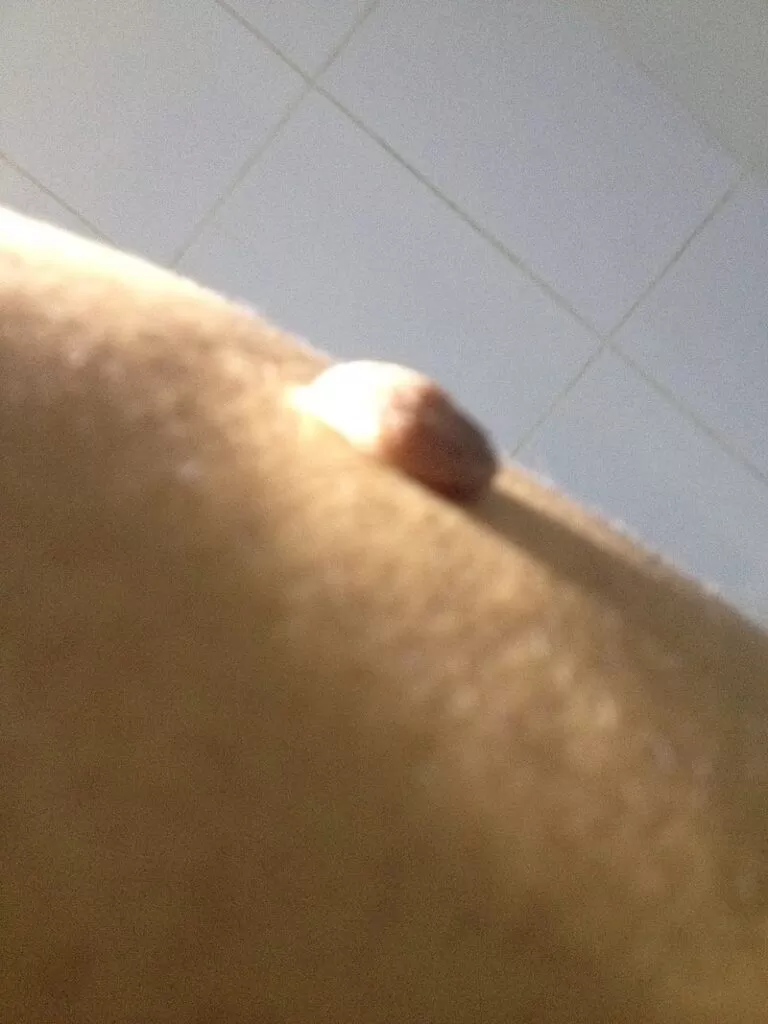 lipoma capsula fibrosa