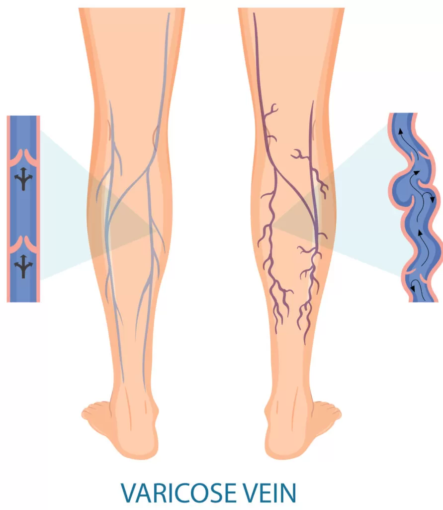 varizes nas pernas