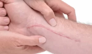 cicatriz hipertrofica